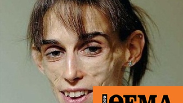 Πάλευε 16 χρόνια με τη νευρική ανορεξία