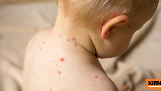 Μακρινός στόχος παραμένει η εξάλειψη της ιλαράς, παραδέχεται ο Παγκόσμιος Οργανισμός Υγείας