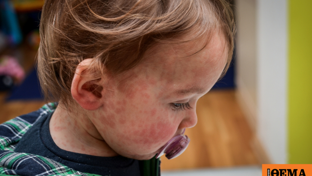 Ιλαρά και ερυθρά «επιστρέφουν» στην Ευρώπη – Η κατάσταση στην Ελλάδα