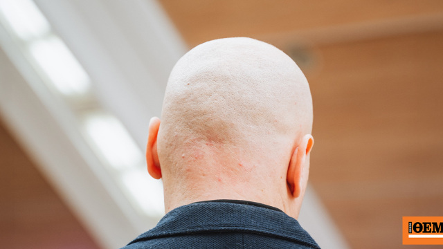 Τέλος η φαλάκρα; Το νέο προϊόν από την Κίνα που υπόσχεται επανεμφάνιση μαλλιών μέσα σε λίγες εβδομάδες